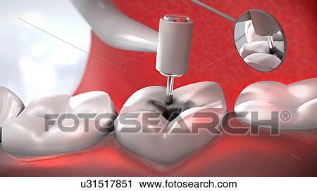 Dental treatment, illustration View Large Photo Image Stock Image - Dental treatment, illustration. Fotosearch