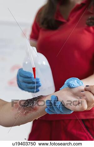Stock Image - First aid training for burns. Fotosearch