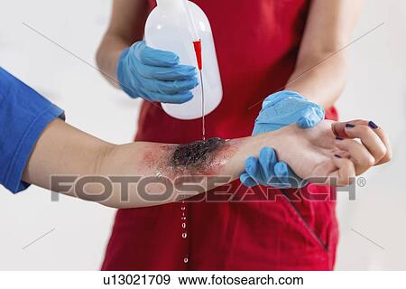 Stock Photo - First aid training for burns. Fotosearch