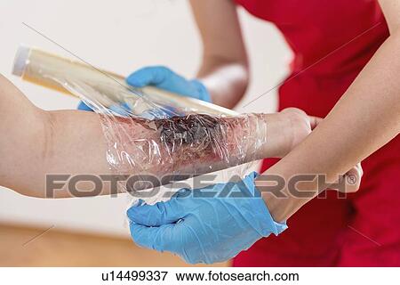 Stock Photo - First aid training for burns. Fotosearch