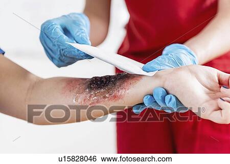 Stock Photograph - First aid training for burns. Fotosearch