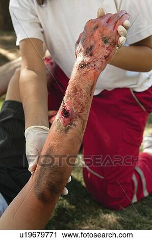 First aid treatment of arm View Large Photo Image Stock Image - First aid treatment of arm. Fotosearch