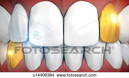 Picture - Gold teeth and tooth gem, illustration. Fotosearch