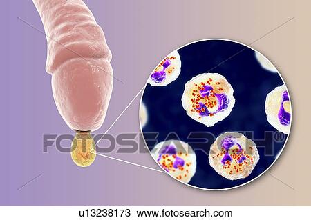 Stock Image - Gonorrhoea infection in male, illustration. Fotosearch