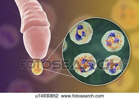 Stock Image - Gonorrhoea infection in male, illustration. Fotosearch