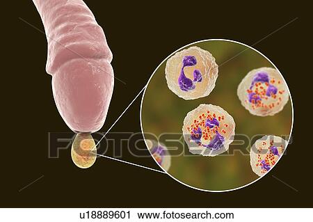 Gonorrhoea infection in male, illustration View Large Photo Image Stock Image - Gonorrhoea infection in male, illustration. Fotosearch