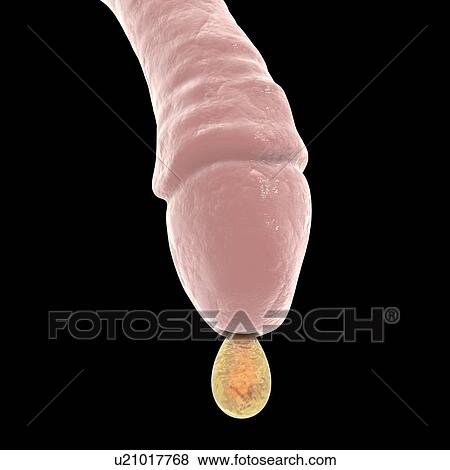 Stock Photo - Gonorrhoea infection in male, illustration. Fotosearch
