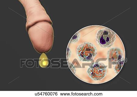 Gonorrhoea infection in male, illustration View Large Photo Image Stock Photograph - Gonorrhoea infection in male, illustration. Fotosearch