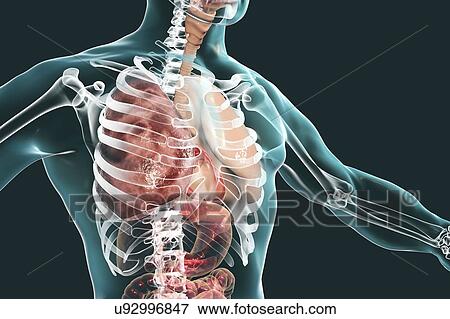 Stock Photo - Grey hepatisation of lobar pneumonia, illustration. Fotosearch