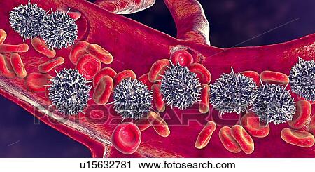 Hairy cell leukaemia, illustration View Large Photo Image Stock Image - Hairy cell leukaemia, illustration. Fotosearch