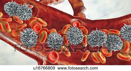 Stock Photo - Hairy cell leukaemia, illustration. Fotosearch