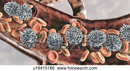 Hairy cell leukaemia, illustration View Large Photo Image Stock Photograph - Hairy cell leukaemia, illustration. Fotosearch