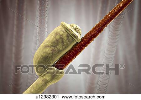 Stock Image - Head louse nits, illustration. Fotosearch