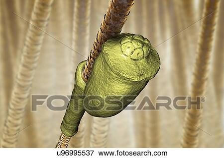 Stock Photo - Head louse nits, illustration. Fotosearch