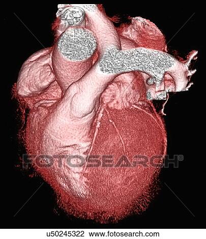 Stock Image - Healthy heart, 3D computed tomography (CT) scan.. Fotosearch