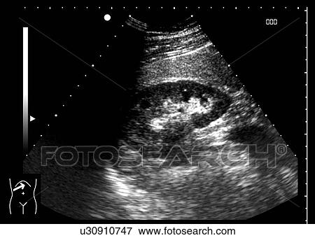 Healthy kidney, ultrasound scan. View Large Photo Image Stock Photo - Healthy kidney, ultrasound scan.. Fotosearch