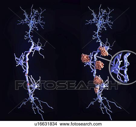 Picture - Healthy neurons and nerve damage in multiple sclerosis. Fotosearch