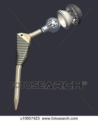 Hip prosthesis, illustration View Large Photo Image Stock Image - Hip prosthesis, illustration. Fotosearch