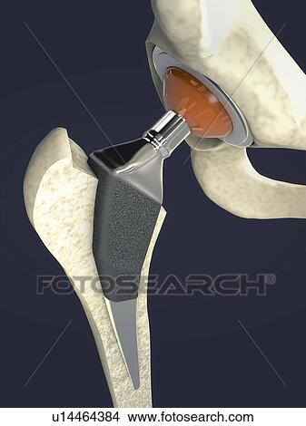 Picture - Hip replacement, illustration. Fotosearch