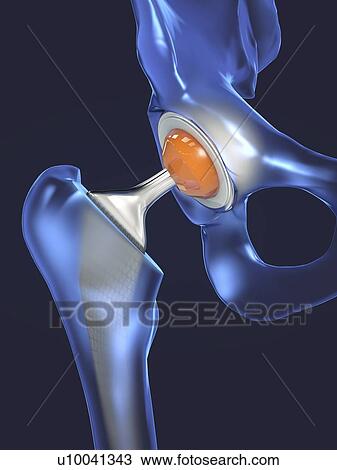 Stock Image - Hip replacement, illustration. Fotosearch