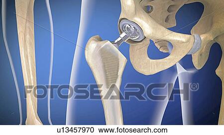 Stock Image - Hip replacement, illustration. Fotosearch