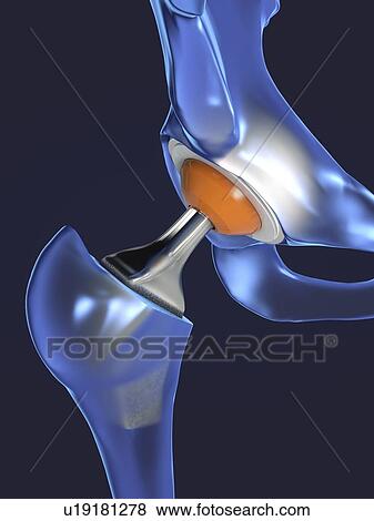 Stock Photo - Hip replacement, illustration. Fotosearch