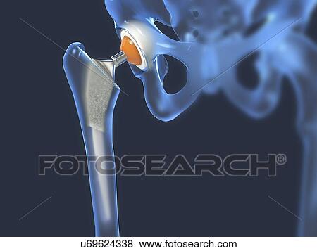 Stock Photo - Hip replacement, illustration. Fotosearch