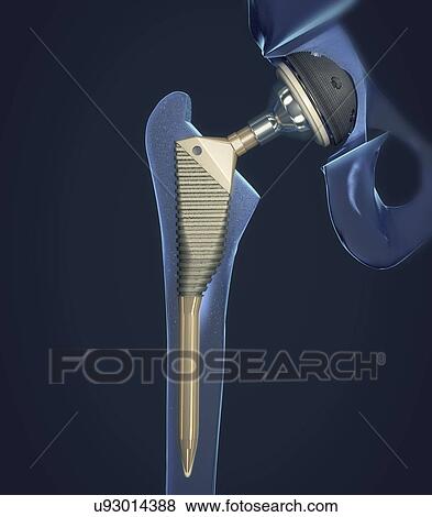 Stock Photo - Hip replacement, illustration. Fotosearch