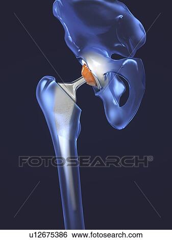 Hip replacement, illustration View Large Photo Image Stock Photograph - Hip replacement, illustration. Fotosearch