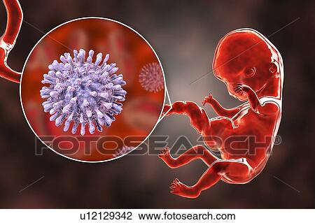 Stock Image - HIV infecting human embryo, illustration. Fotosearch