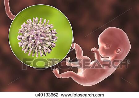 Stock Image - HIV infecting human embryo, illustration. Fotosearch