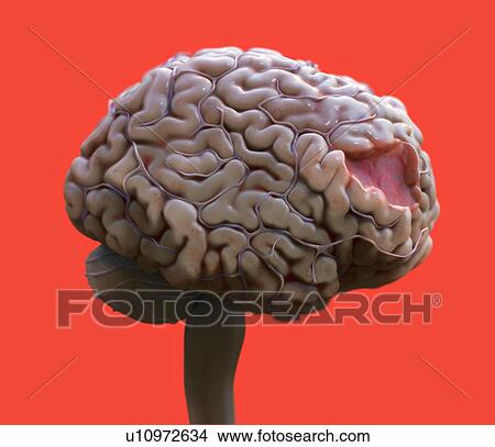 Picture - Human brain damage, illustration.. Fotosearch
