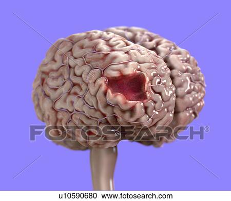 Stock Image - Human brain damage, illustration.. Fotosearch