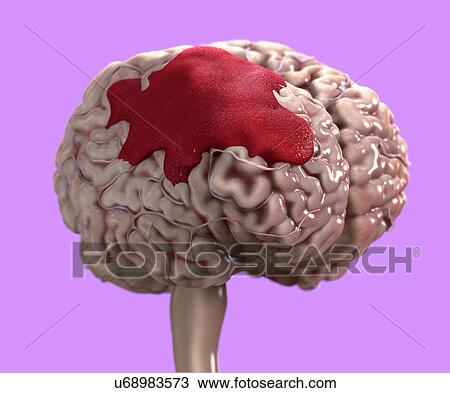 Human brain haemorrhage, illustration. View Large Photo Image Stock Image - Human brain haemorrhage, illustration.. Fotosearch