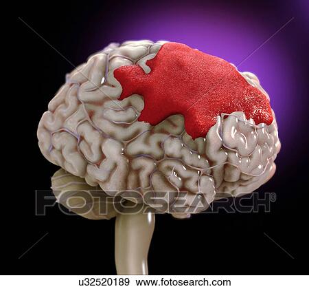 Stock Photo - Human brain haemorrhage, illustration.. Fotosearch