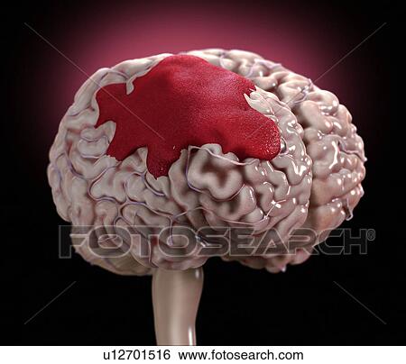 Human brain haemorrhage, illustration. View Large Photo Image Stock Photograph - Human brain haemorrhage, illustration.. Fotosearch