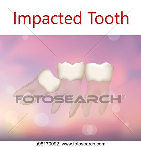 Stock Image - Impacted tooth, illustration. Fotosearch