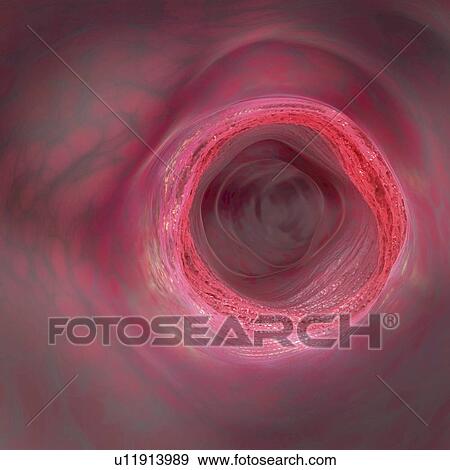 Stock Photo - Inflammatory bowel disease, illustration. Fotosearch