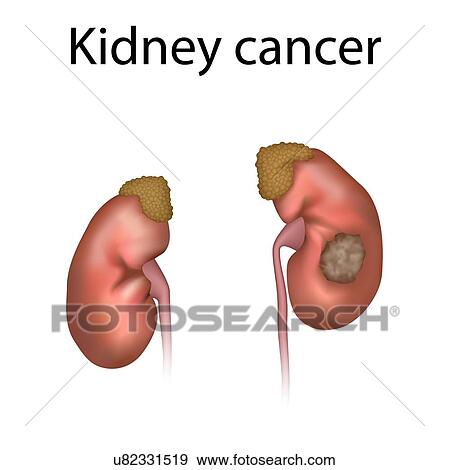 Kidney cancer, illustration View Large Photo Image Stock Photo - Kidney cancer, illustration. Fotosearch