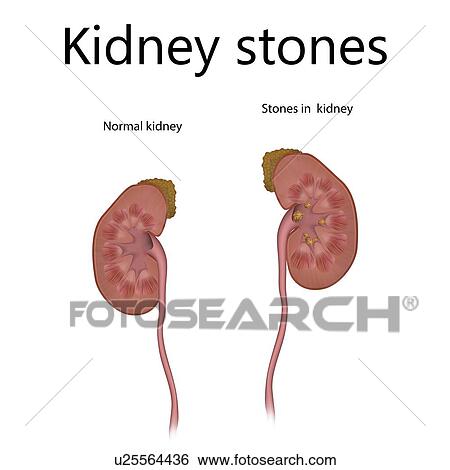 Kidney stones, illustration View Large Photo Image Stock Photograph - Kidney stones, illustration. Fotosearch