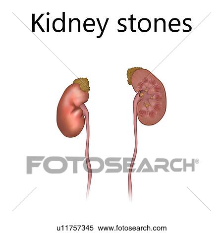Kidney stones, illustration View Large Photo Image Stock Photography - Kidney stones, illustration. Fotosearch