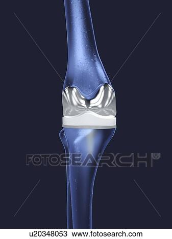 Stock Image - Knee replacement, illustration. Fotosearch