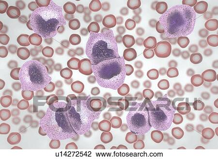 Stock Image - Leukaemia, illustration. Fotosearch