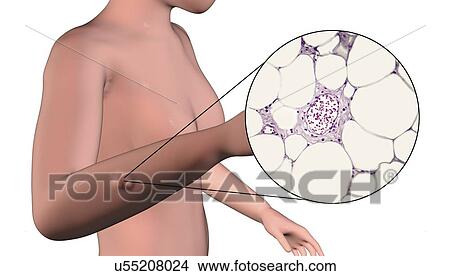 Picture - Lipoma, composite image. Fotosearch