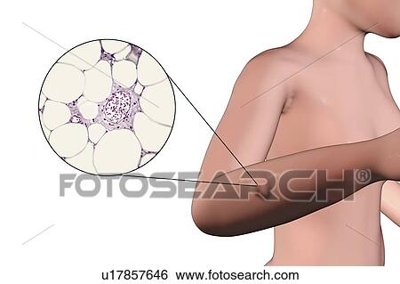 Stock Photograph - Lipoma, composite image. Fotosearch