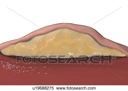 Lipoma, cross-section, illustration View Large Photo Image Stock Photography - Lipoma, cross-section, illustration. Fotosearch