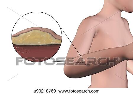 Lipoma, illustration View Large Photo Image Stock Photo - Lipoma, illustration. Fotosearch