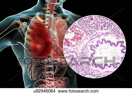 Lobar pneumonia, illustration and light micrograph View Large Photo Image Picture - Lobar pneumonia, illustration and light micrograph. Fotosearch