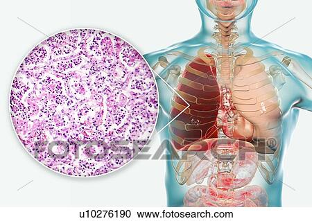 Stock Image - Lobar pneumonia, illustration and light micrograph. Fotosearch