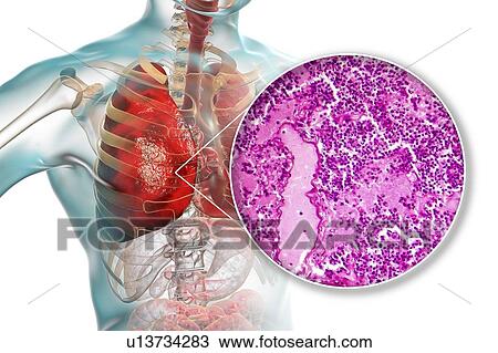 Stock Image - Lobar pneumonia, illustration and light micrograph. Fotosearch
